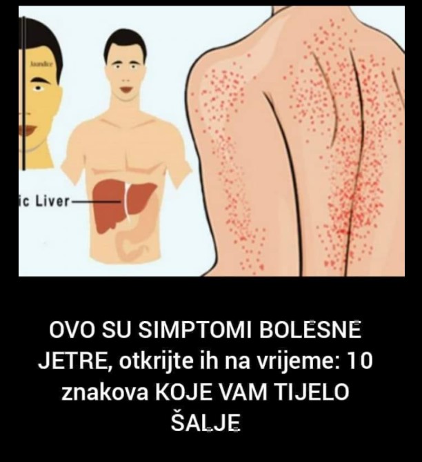 Ovo Su Simptomi Bolesne Jetre Otkrijte Ih Na Vrijeme Znakova Koje