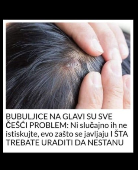 BUBULJICE NA GLAVI SU SVE ČEŠĆI PROBLEM Ni slučajno ih ne istiskujte