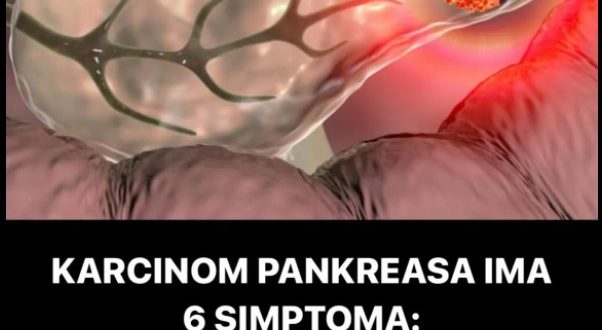 KARCINOM PANKREASA IMA 6 SIMPTOMA: Karcinom dugo i tiho raste, a onda se javlja ovaj znak